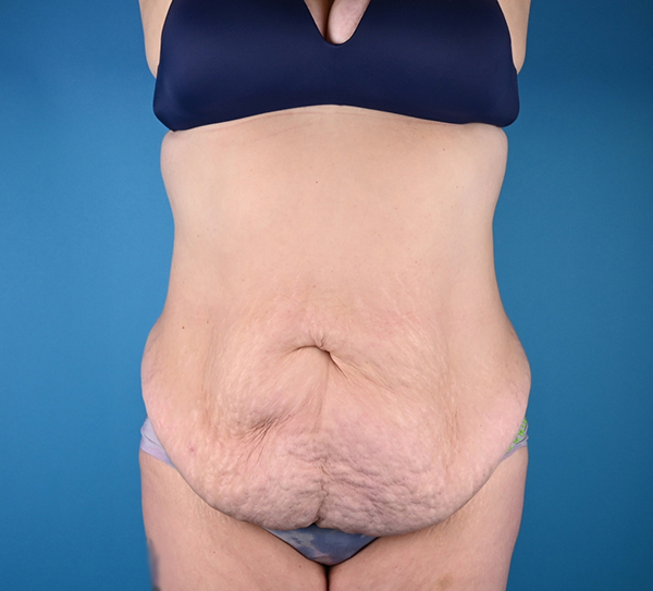 Before abdominoplasty Front View