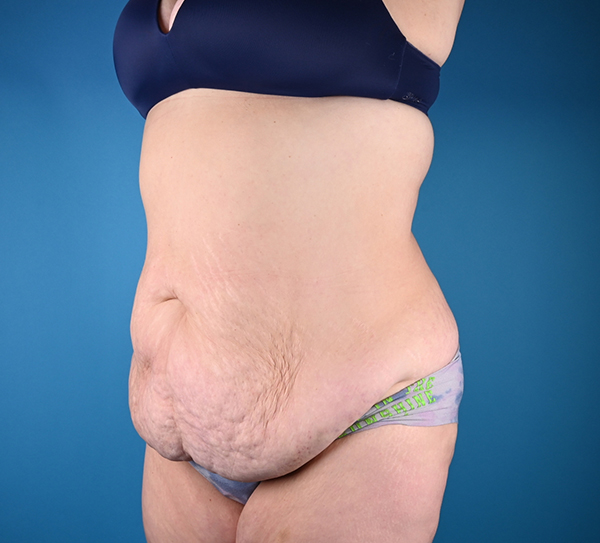 Before abdominoplasty Left Oblique View