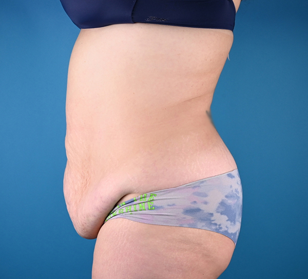Before abdominoplasty Left Side View