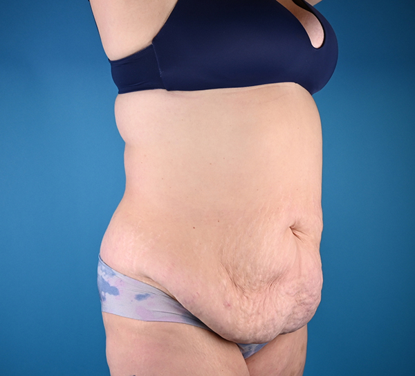 Before abdominoplasty Right Oblique View