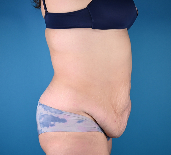 Before abdominoplasty Right Side View