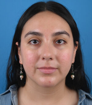 After ethnic rhinoplasty Front View
