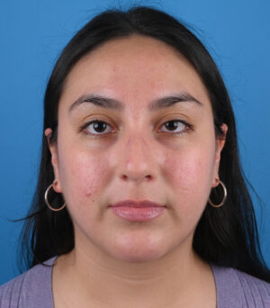 Before ethnic rhinoplasty Front View