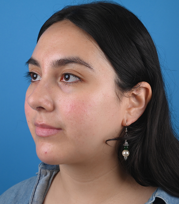 After ethnic rhinoplasty Left Oblique View