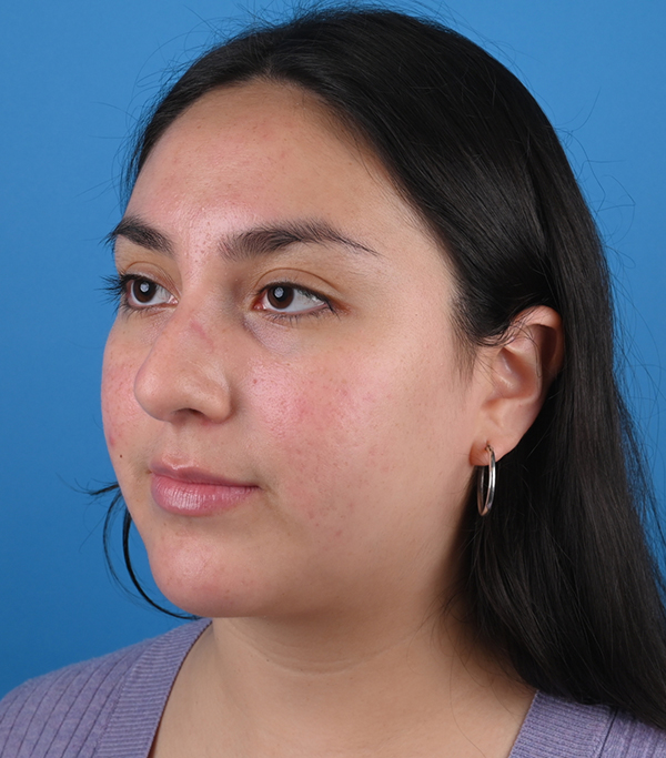 Before ethnic rhinoplasty Left Oblique View