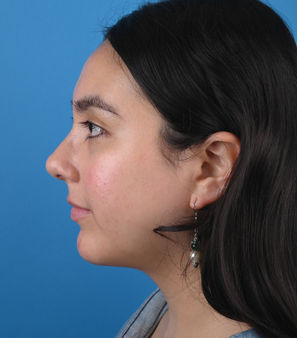 After ethnic rhinoplasty Left Side View
