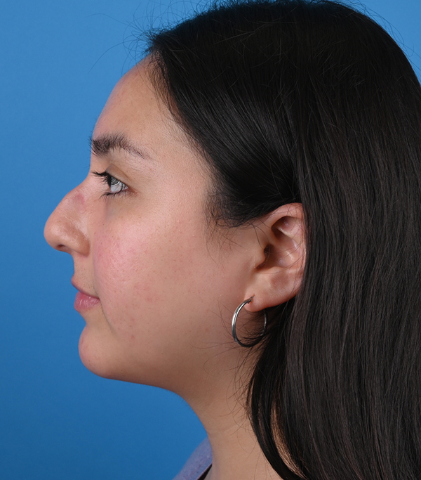 Before ethnic rhinoplasty Left Side View