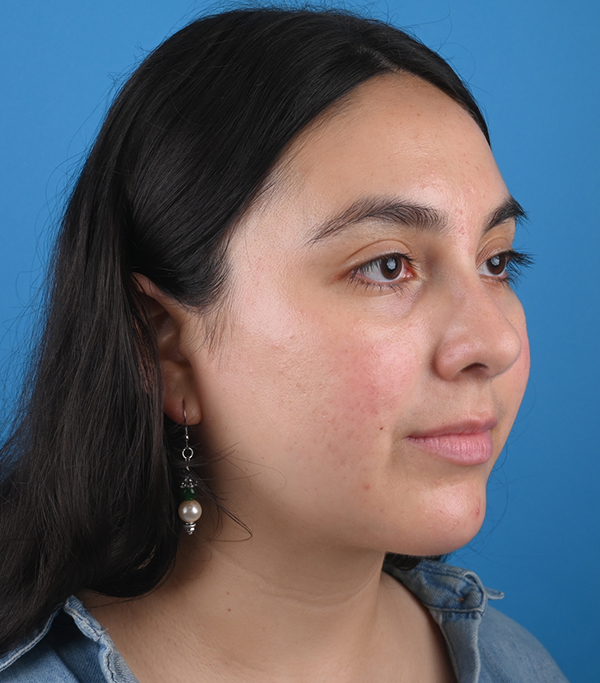 After ethnic rhinoplasty Right Oblique View