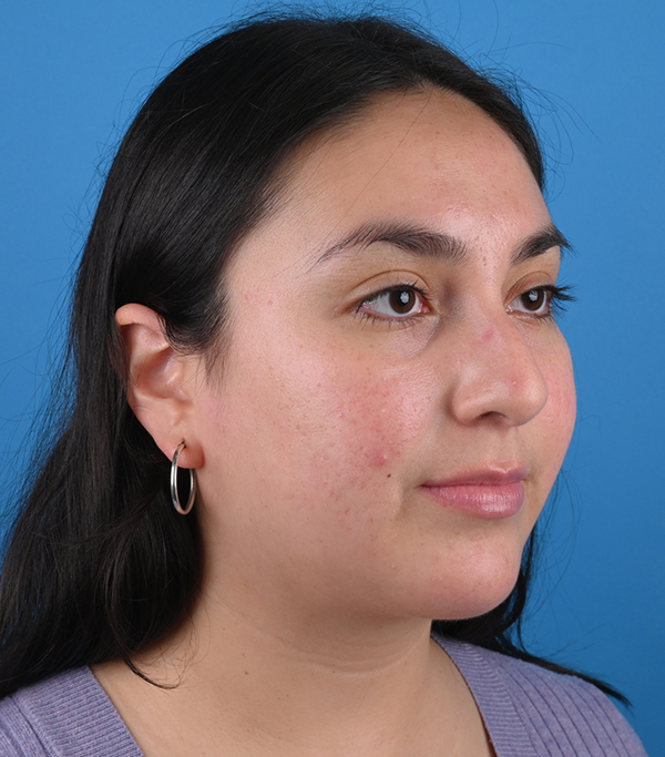 Before ethnic rhinoplasty Right Oblique View