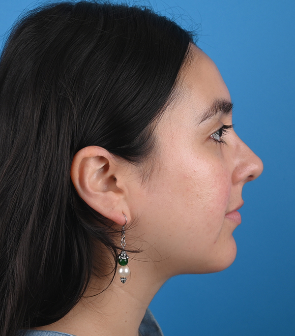 After ethnic rhinoplasty Right Side View