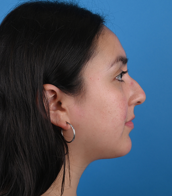 Before ethnic rhinoplasty Right Side View