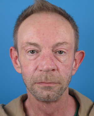 front view after blepharoplasty by dr. patel
