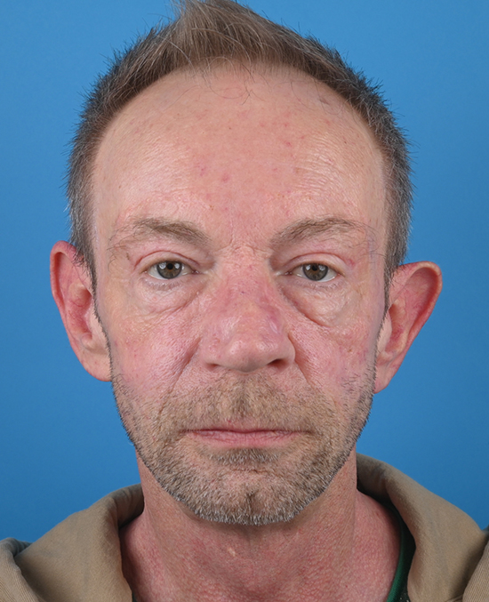front view after blepharoplasty by dr. patel