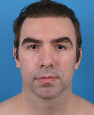 front view after genioplasty & blepharoplasty