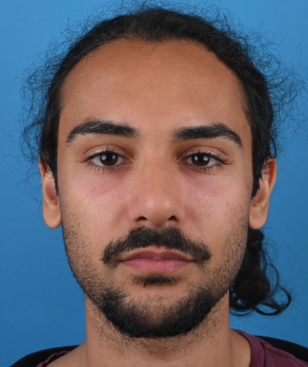 front view after rhinoplasty