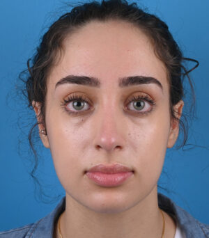 front view after rhinoplasty by dr. patel front view after rhinoplasty by dr. patel