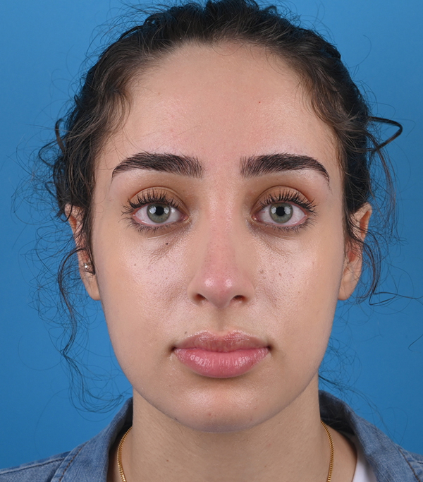 front view after rhinoplasty by dr. patel