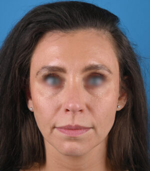 front view after rhinoplasty by dr. patel front view after rhinoplasty by dr. patel