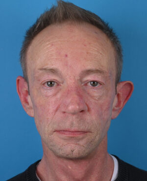 front view before blepharoplasty by dr. patel