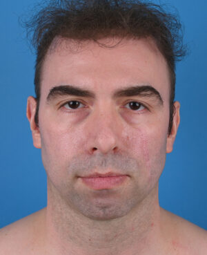 front view before genioplasty & blepharoplasty