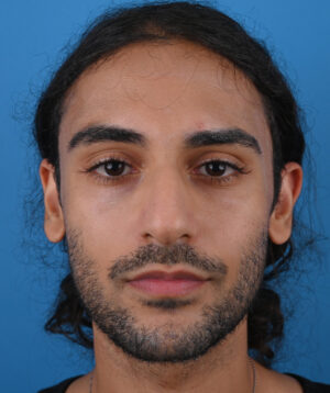 front view before rhinoplasty front view before rhinoplasty