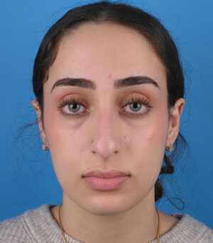 front view before rhinoplasty by dr. patel front view before rhinoplasty by dr. patel