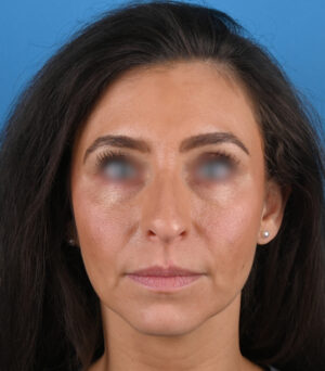 front view before rhinoplasty by dr. patel front view before rhinoplasty by dr. patel