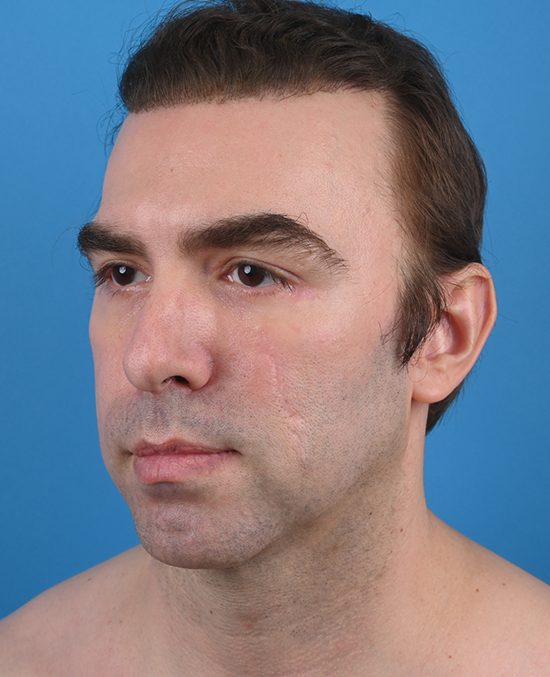 left oblique view after genioplasty & blepharoplasty