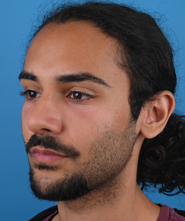 left oblique view after rhinoplasty