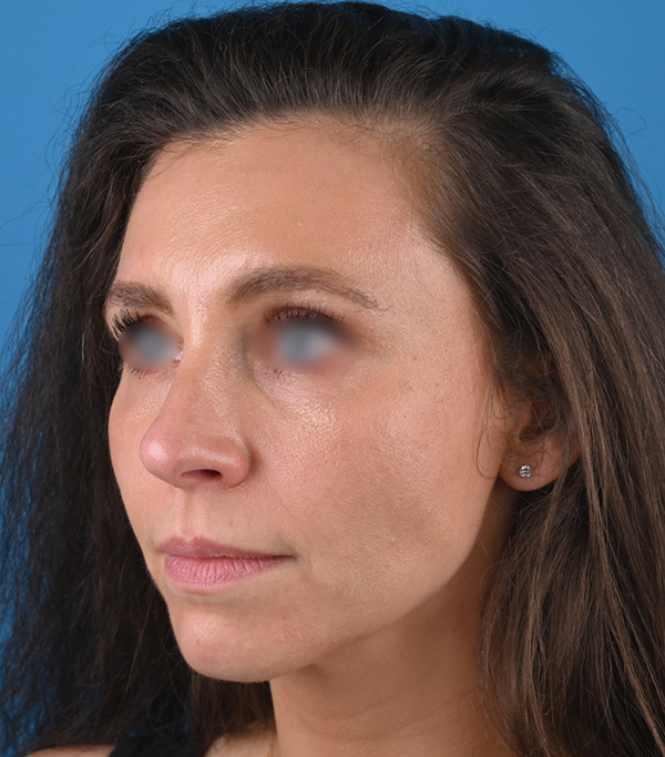 left oblique view after rhinoplasty by dr. patel