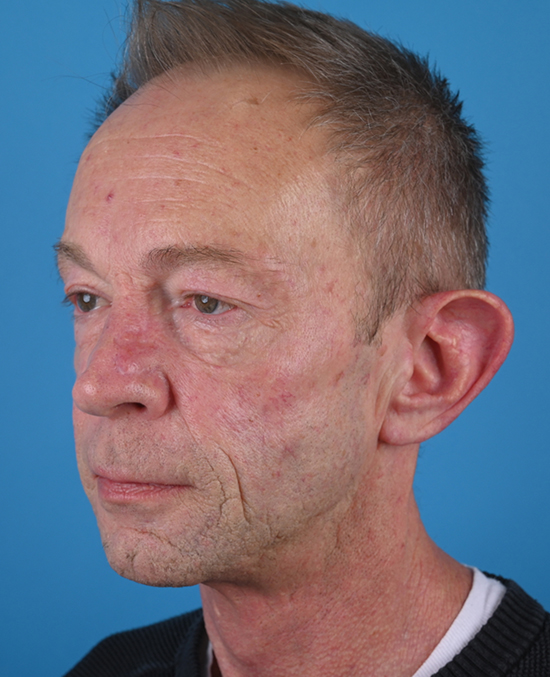 left oblique view before blepharoplasty by dr. patel