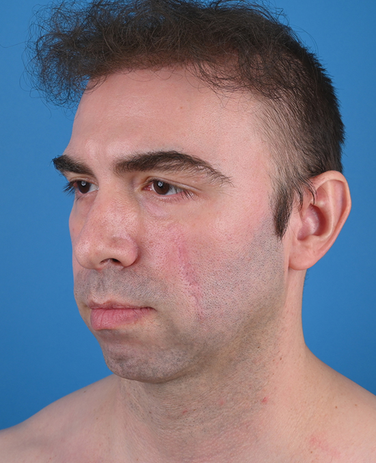 left oblique view before genioplasty & blepharoplasty