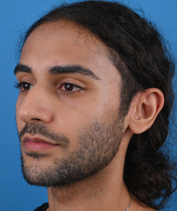 left oblique view before rhinoplasty