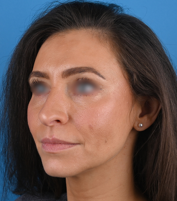 left oblique view before rhinoplasty by dr. patel