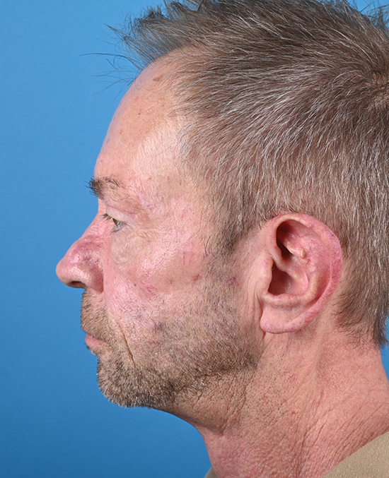 left side view after blepharoplasty by dr. patel