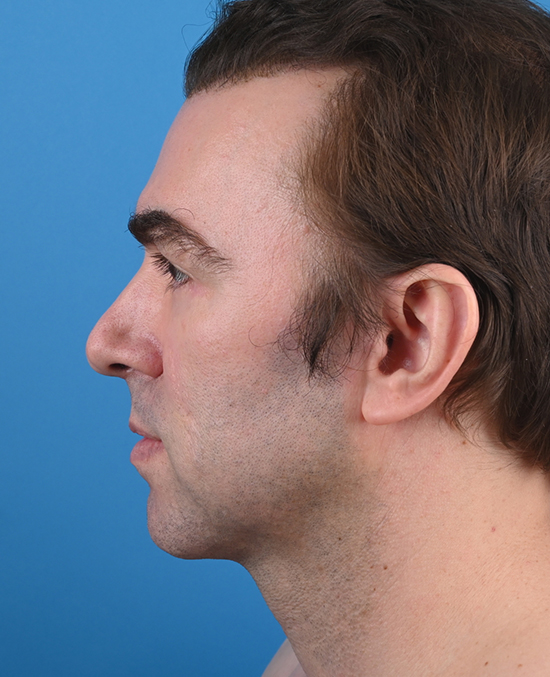 left side view after genioplasty & blepharoplasty