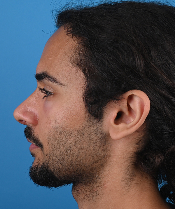 left side view after rhinoplasty