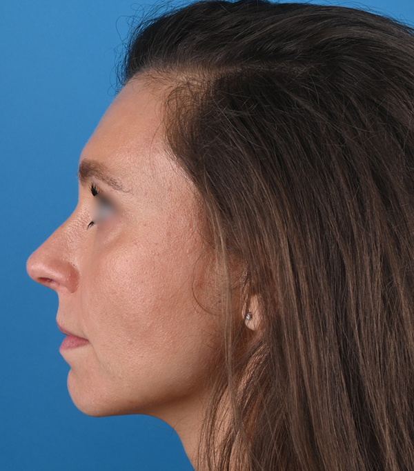 left side view after rhinoplasty by dr. patel