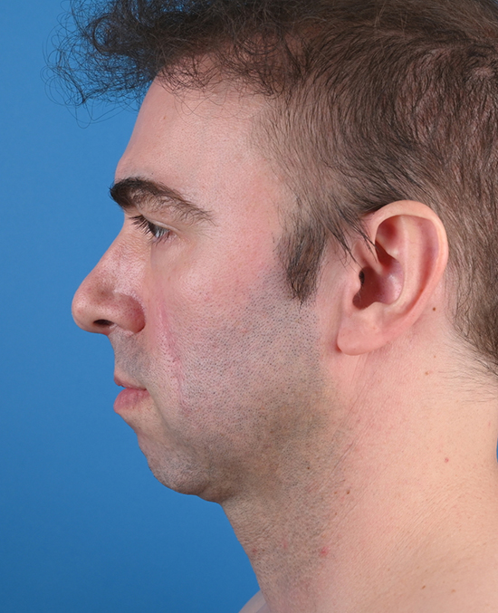left side view before genioplasty & blepharoplasty