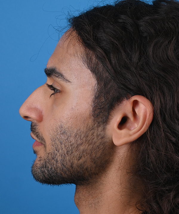 left side view before rhinoplasty