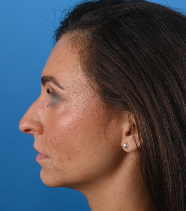 left side view before rhinoplasty by dr. patel