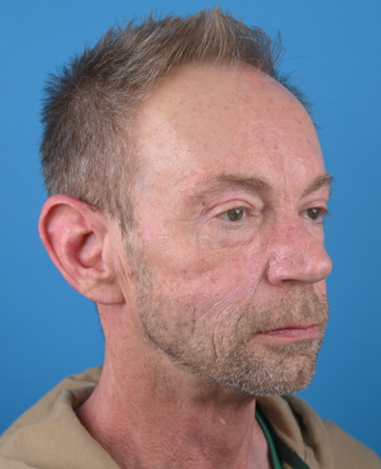 right oblique view after blepharoplasty by dr. patel