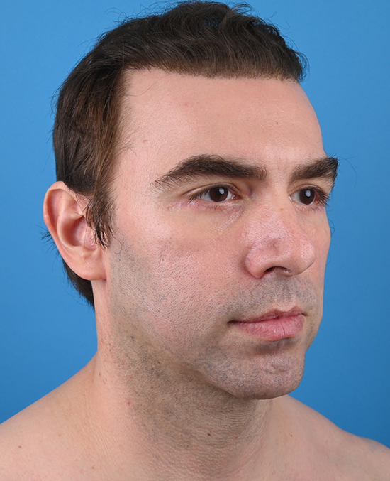 right oblique view after genioplasty & blepharoplasty