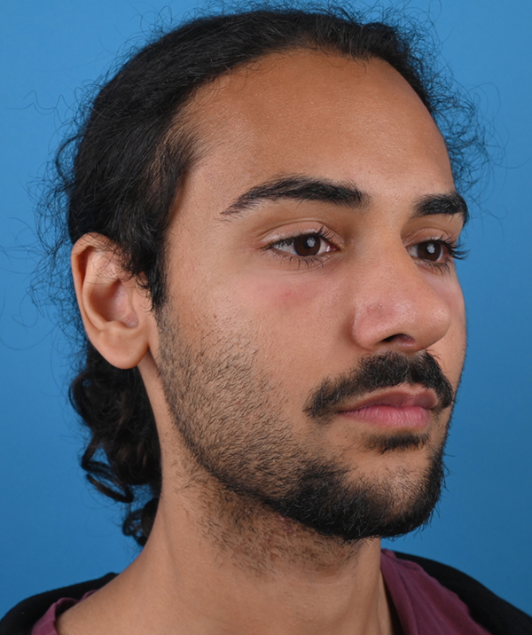 right oblique view after rhinoplasty
