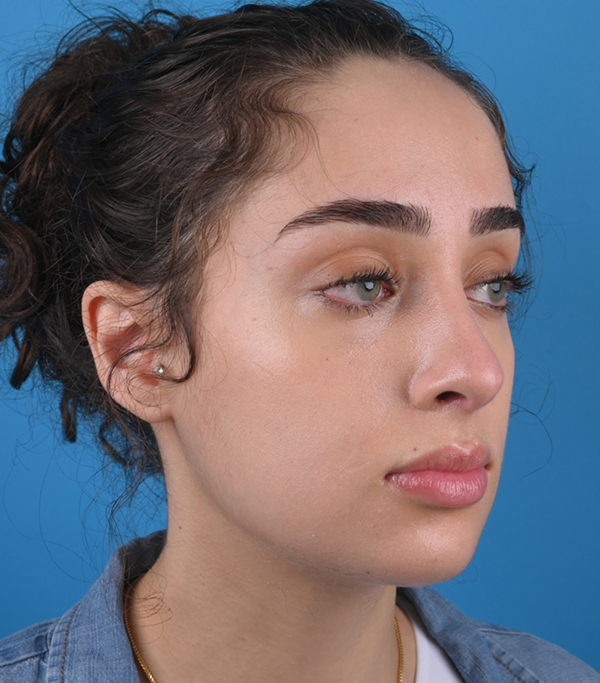 right oblique view after rhinoplasty by dr. patel