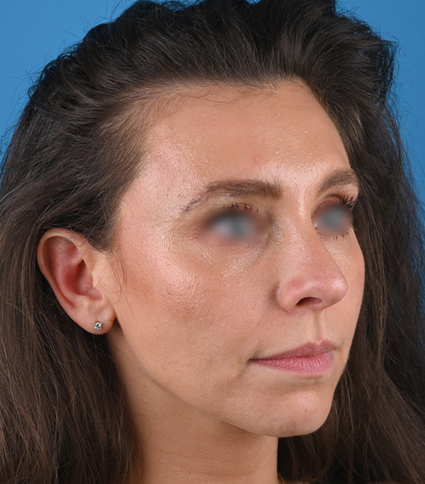 right oblique view after rhinoplasty by dr. patel