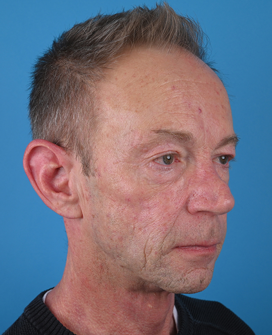 right oblique view before blepharoplasty by dr. patel