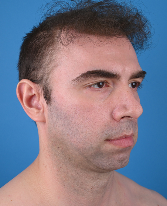 right oblique view before genioplasty & blepharoplasty