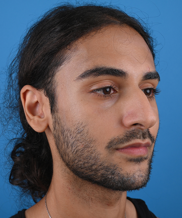 right oblique view before rhinoplasty