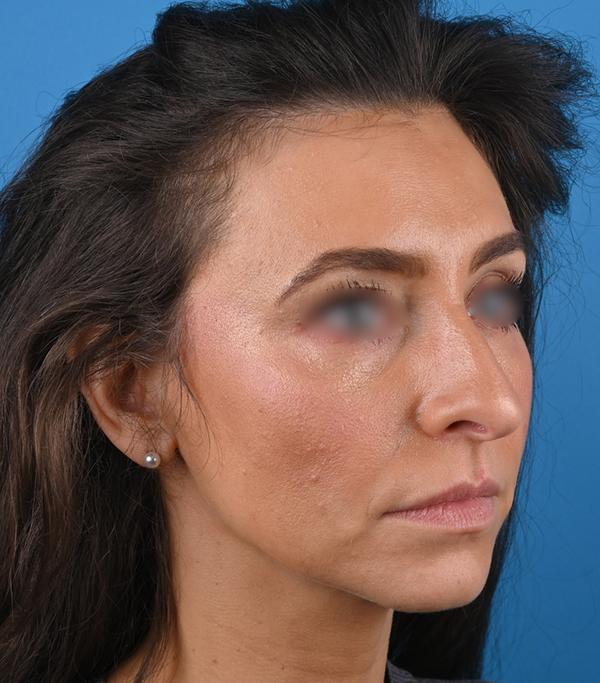 right oblique view before rhinoplasty by dr. patel